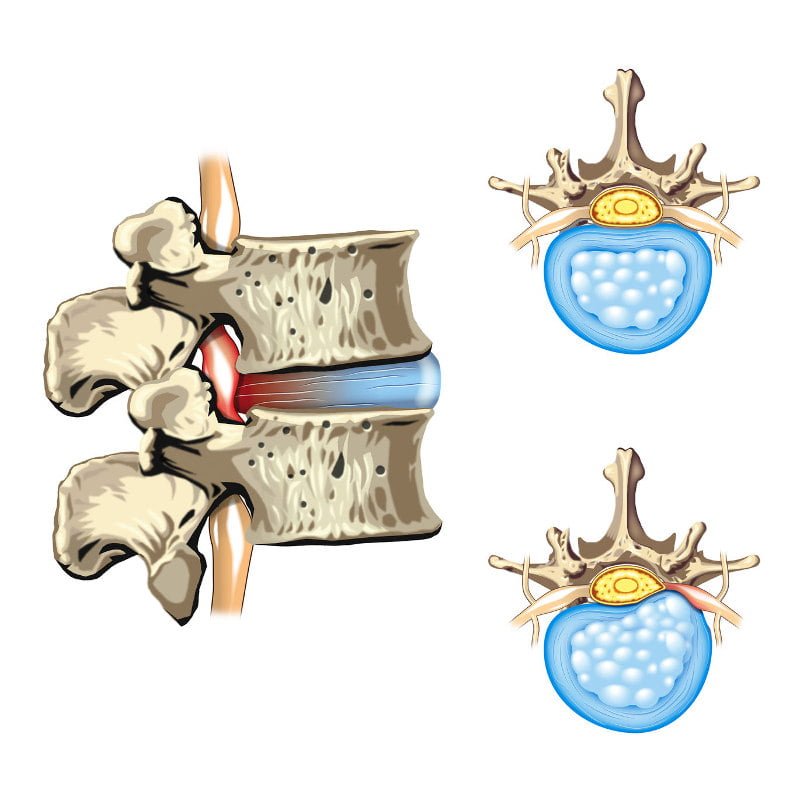 A diagram showing a disc bulge or herniation