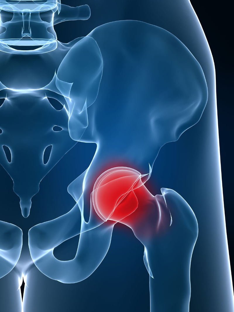 An xray of the hip joint showing where arthritis can occur