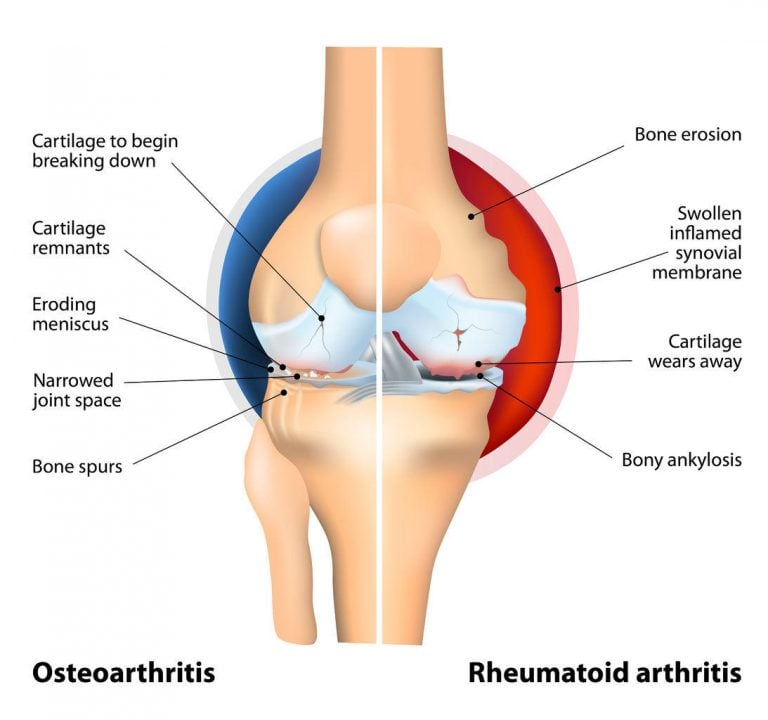 Diagram of a knee joint comparing signs and symptoms of rheumatoid arthritis and osteoarthritis