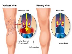 A diagram of a leg with varicose veins