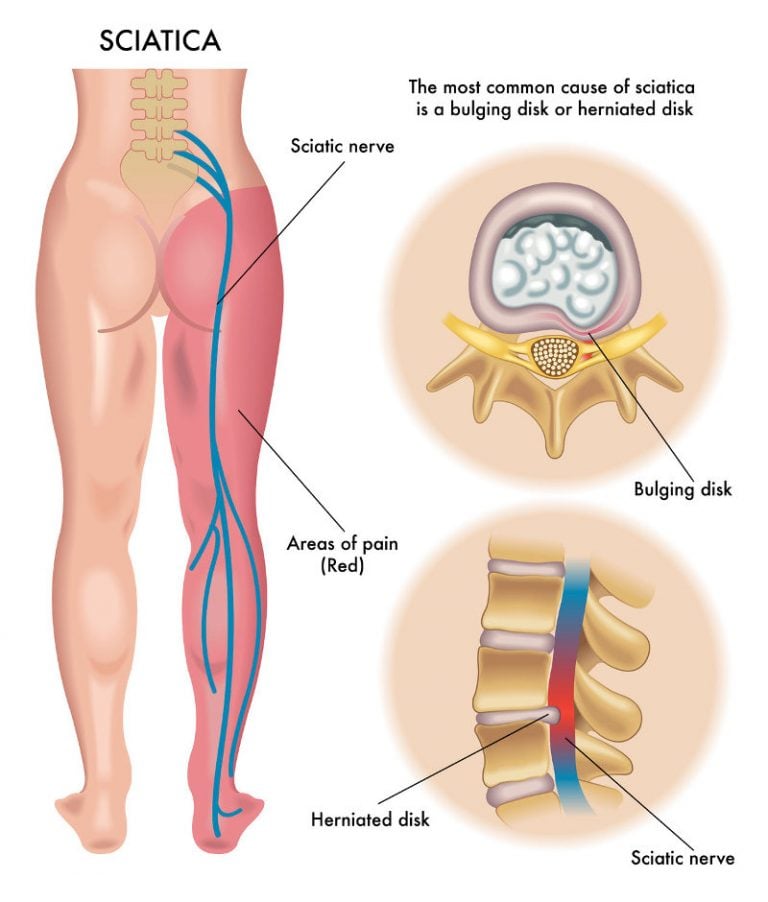 Diagram showing how sciatica cam be caused by a lumbar disc injury disc bulge or herniation